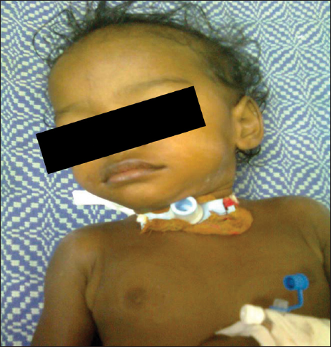 Child with tracheostomy tube.